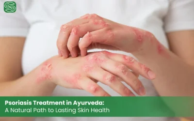 Psoriasis Treatment in Ayurveda: A Natural Path to Lasting Skin Health