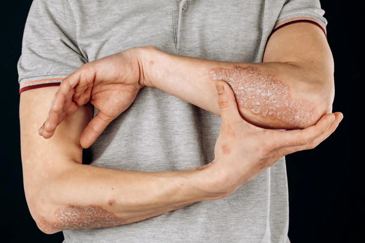 ayurveda-psoriasis-treatment.webp