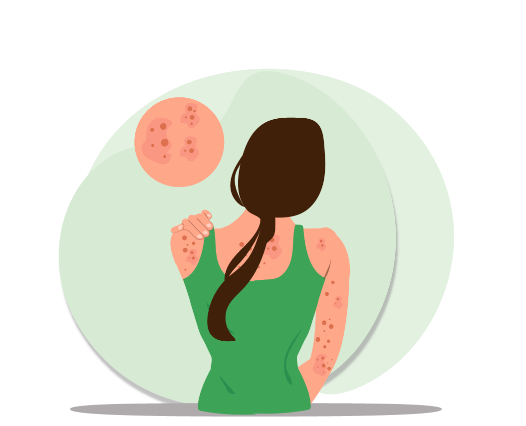 ayurvedic-treatment-for-skin-rashes. webp